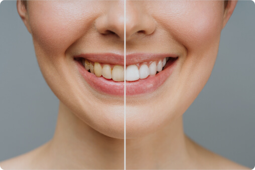 Teeth Whitening in Boca Raton | Cosmetic Dentist & Dental Doctor