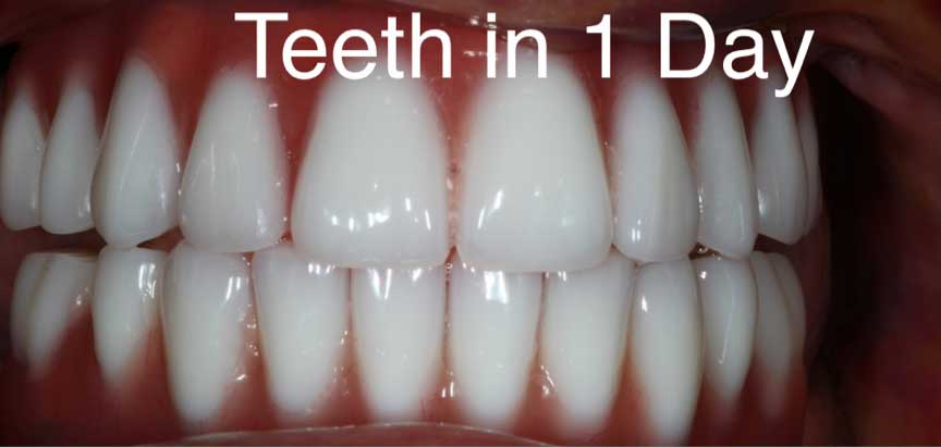 Teeth In A Day | Boca Dental Implants, FL | Call 561-391-6606