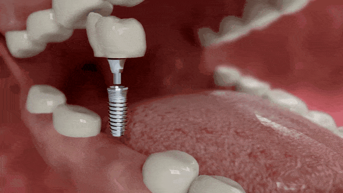 Dental Implants Dentist in Boca Raton, FL | Call 561-408-6459